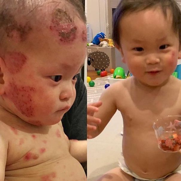 Baby Colby overcomes severe TSW Topical Steroid Withdrawal
