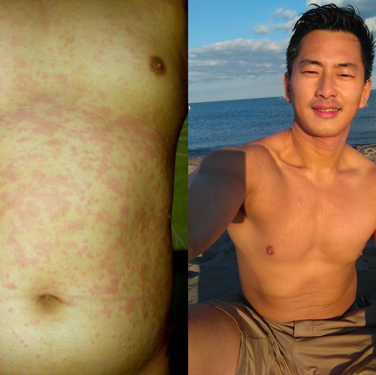A before and after image of Kevan Kwok, creator of The Hypoallergenic Diet and founder of Aether Health. The image shows his skin before and after The Hypoallergenic Diet
